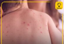 3 дугаар сарын 4-ний байдлаар улаанбурхан өвчний батлагдсан тохиолдол 3-аар нэмэгджээ