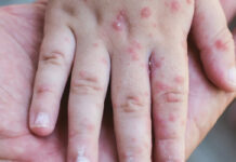 Улаанбурхан өвчнөөр 56 хүн хэвтэн эмчлүүлж байна